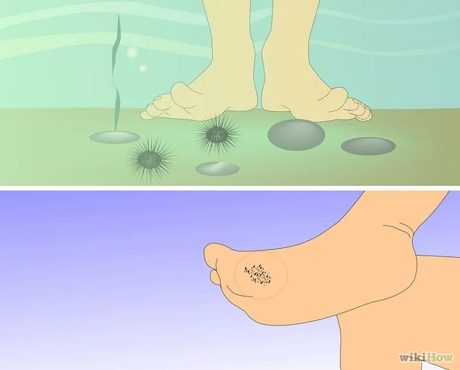 Sea urchin first aid